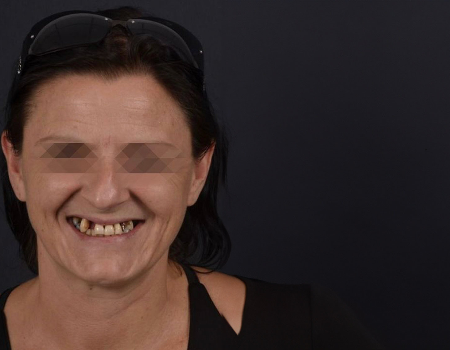 1-chica-con-dientes-deteriorados