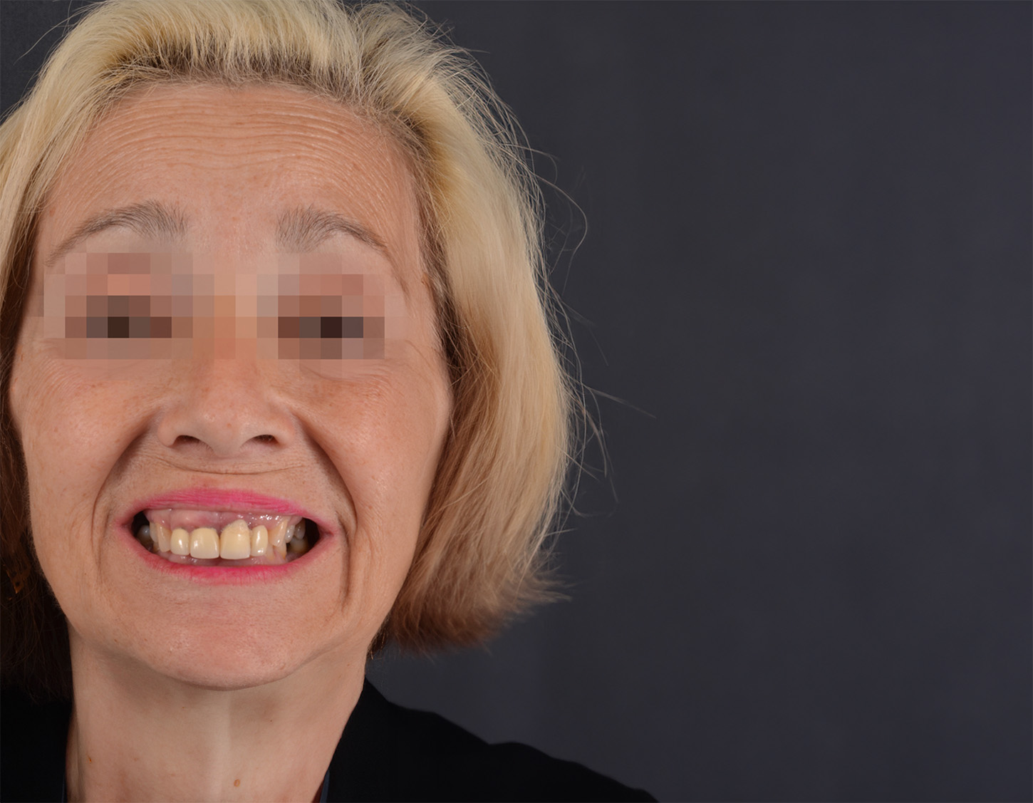 seniora-antes-de-cambio